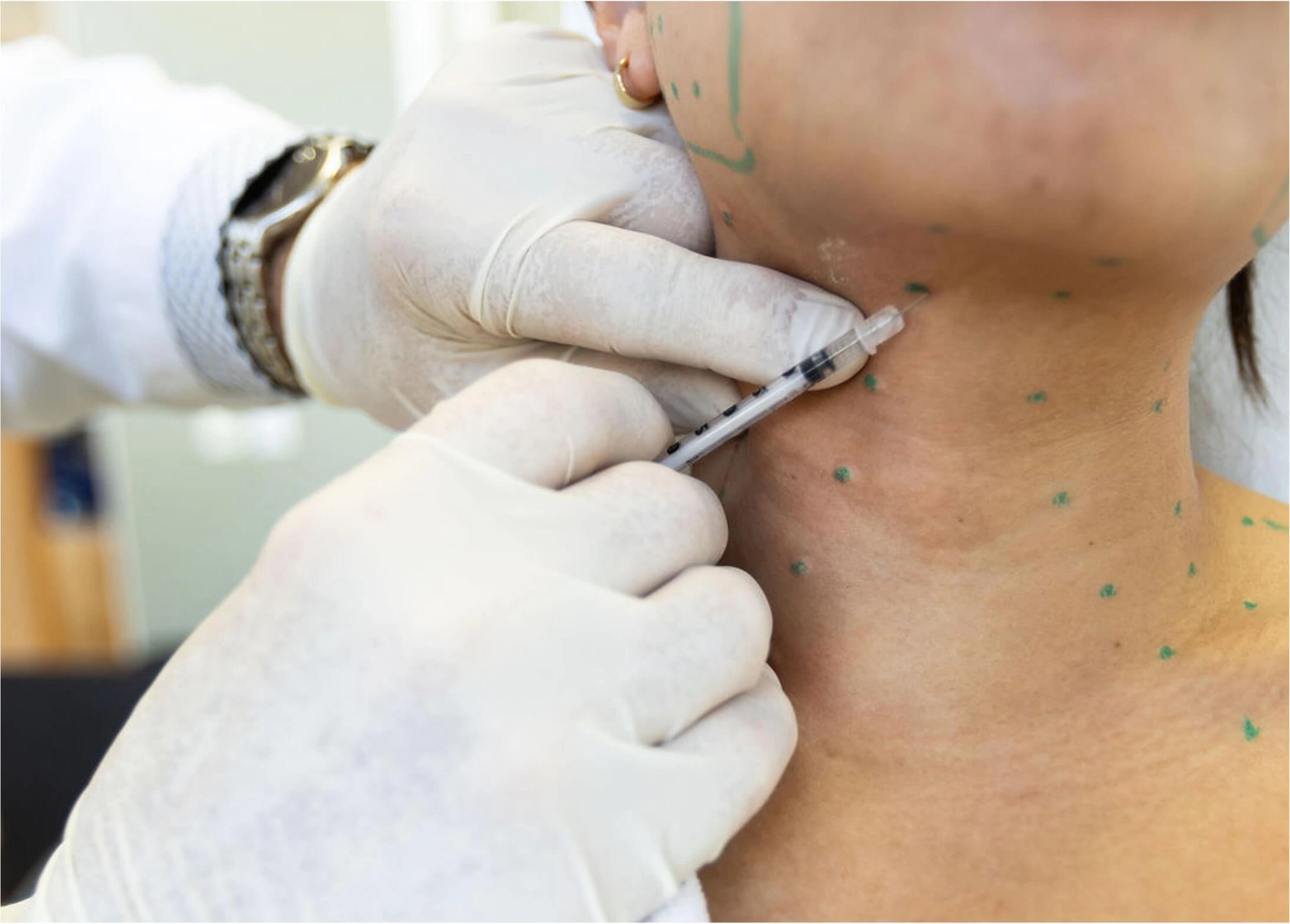 Woman receiving Botox injections in her platysma bands/neck by a dentist.